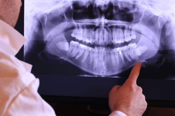 Best Emergency Wisdom Teeth Removal in Sabina, OH
