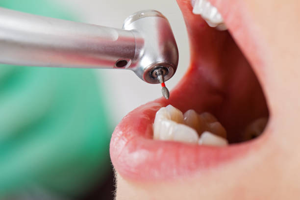 Best Emergency Tooth Extraction in Sabina, OH